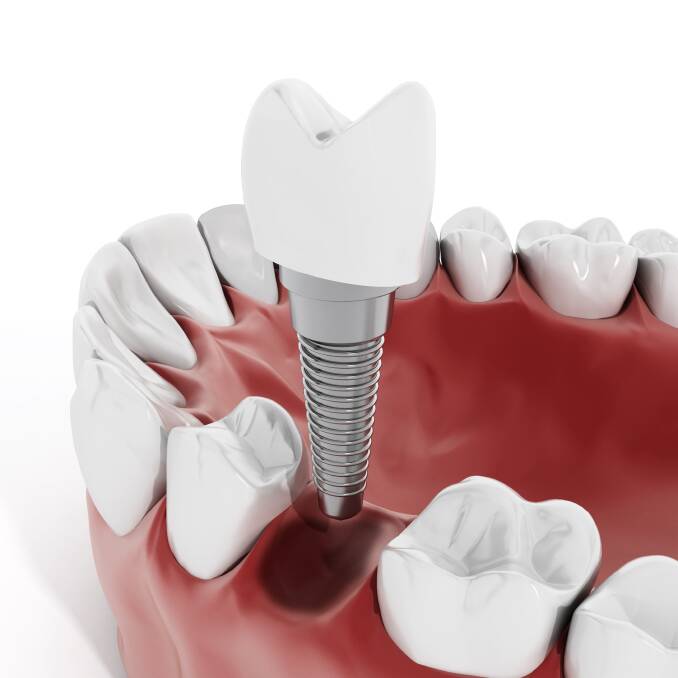 TREATMENT OPTION: Dental implants are an option for people who would like to regain full function and improve their self-confidence. Implants replace missing teeth.