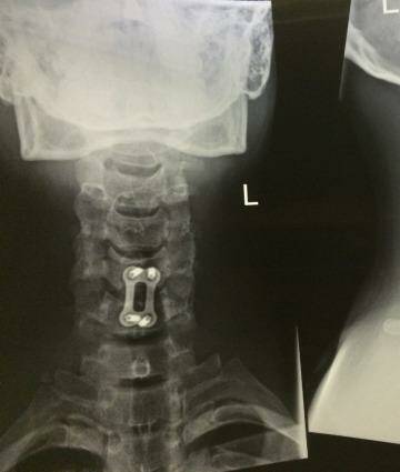 Post-op X-ray of Keith Lulia's neck with the inserted plate highlighted. Photo: Supplied