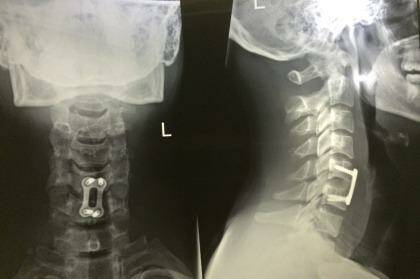 Post-op X-ray of Keith Lulia's neck with the inserted plate highlighted. Photo: Supplied