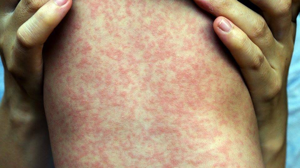 ALERT: Queensland Health has revealed 15 Measles cases south of Brisbane this month.