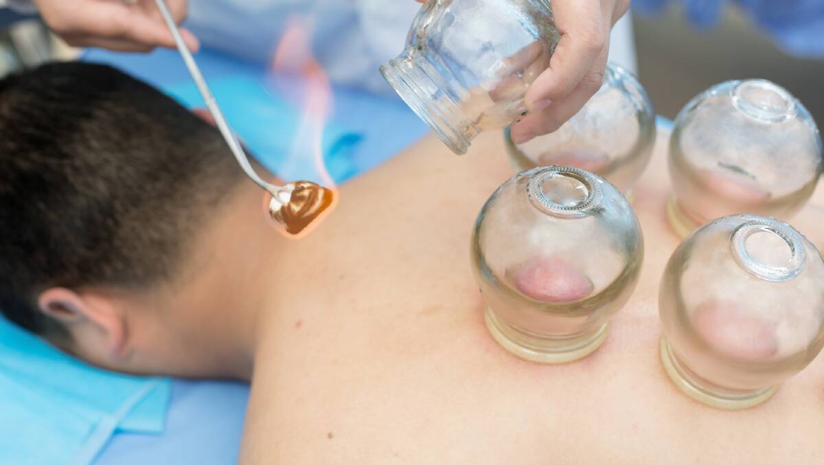 HELP AT HAND: Traditional Chinese medicine, acupuncture and fire cupping (pictured) can be used to help relieve pain of most places in the body.