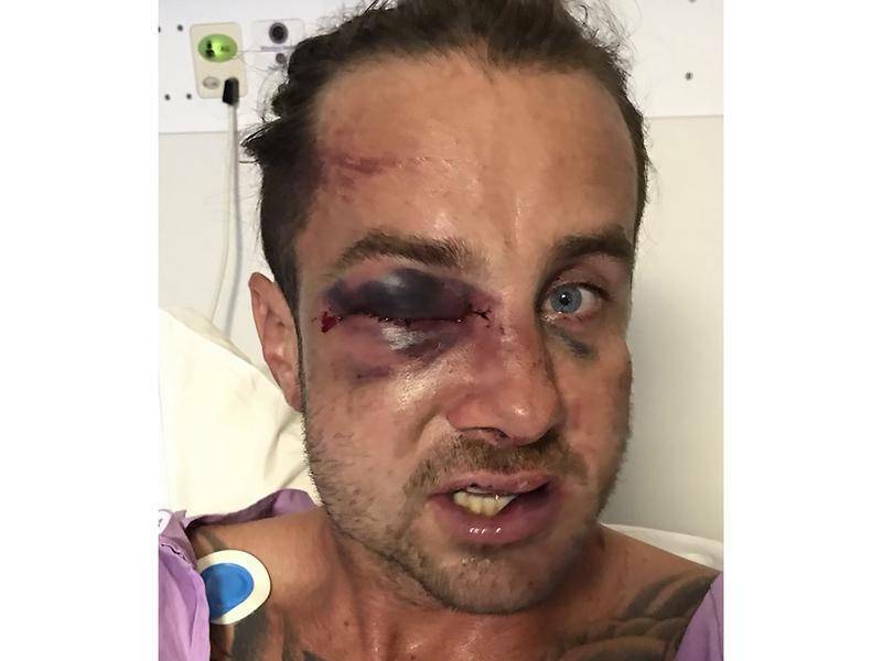BRAWL: Josh Jones sustained serious facial injuries in what police say appeared an unprovoked attack.